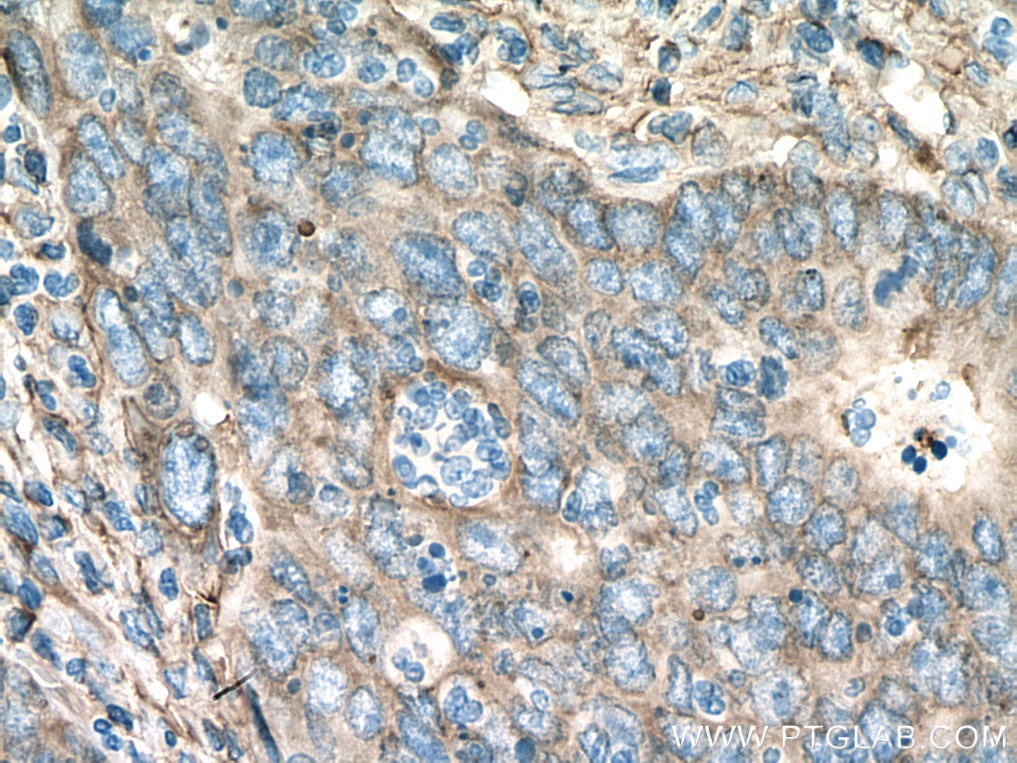 Immunohistochemistry (IHC) staining of human colon cancer tissue using Annexin A2 Polyclonal antibody (11256-1-AP)