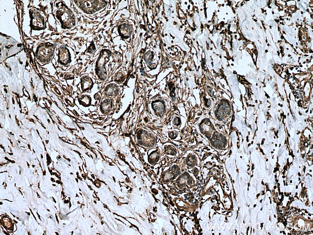 Immunohistochemistry (IHC) staining of human breast cancer tissue using Annexin A2 Polyclonal antibody (11256-1-AP)