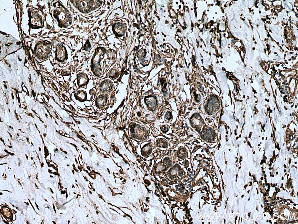 IHC staining of human breast cancer using 11256-1-AP