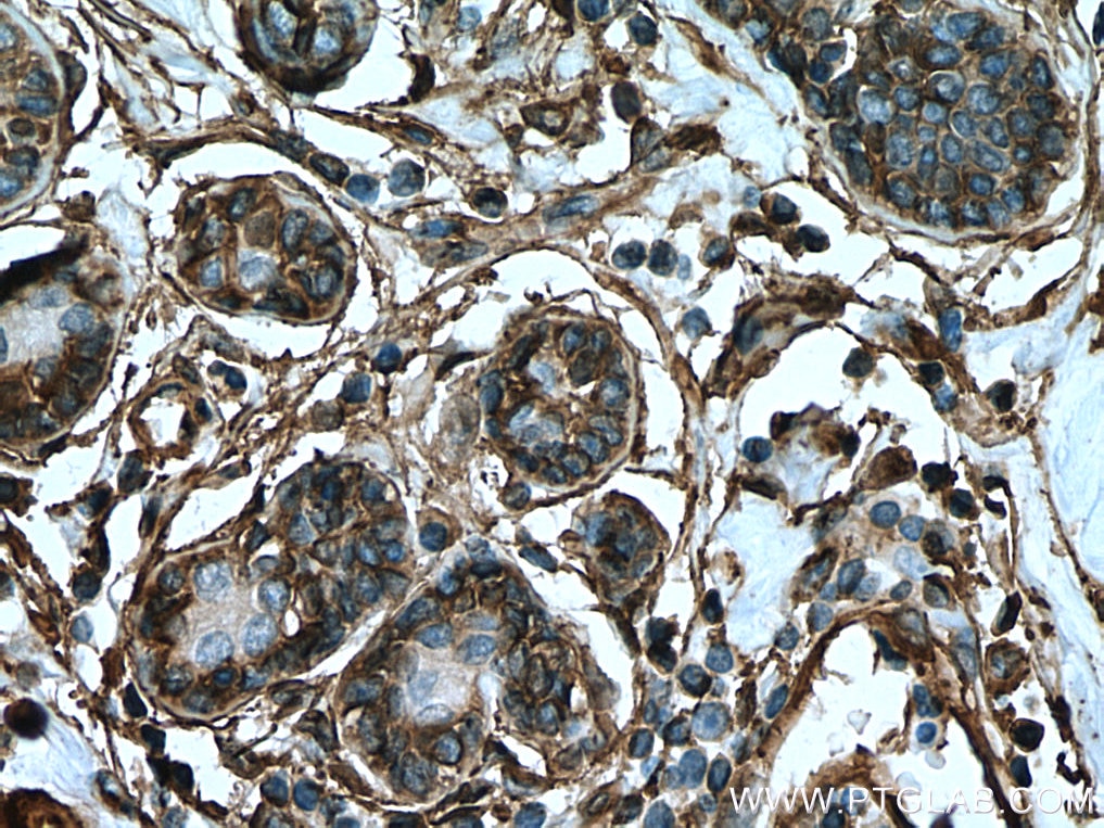 Immunohistochemistry (IHC) staining of human breast cancer tissue using Annexin A2 Polyclonal antibody (11256-1-AP)