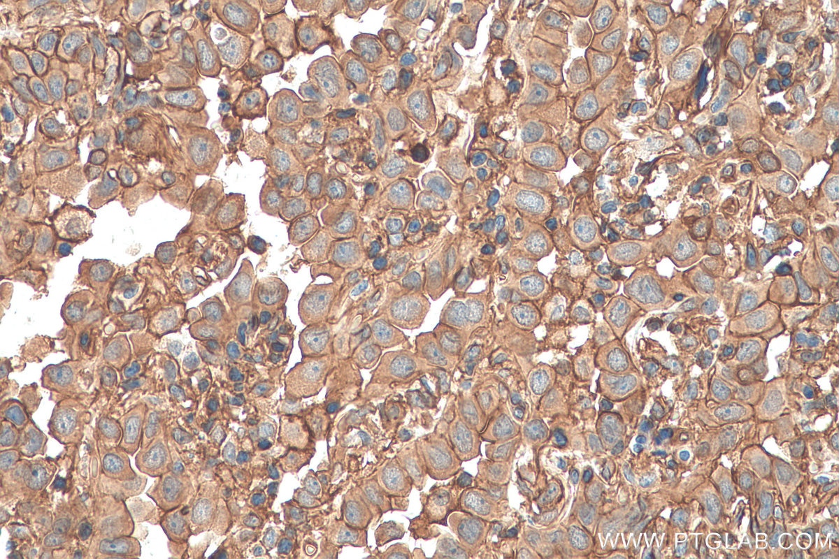Immunohistochemistry (IHC) staining of human lung cancer tissue using Annexin A2 Polyclonal antibody (11256-1-AP)