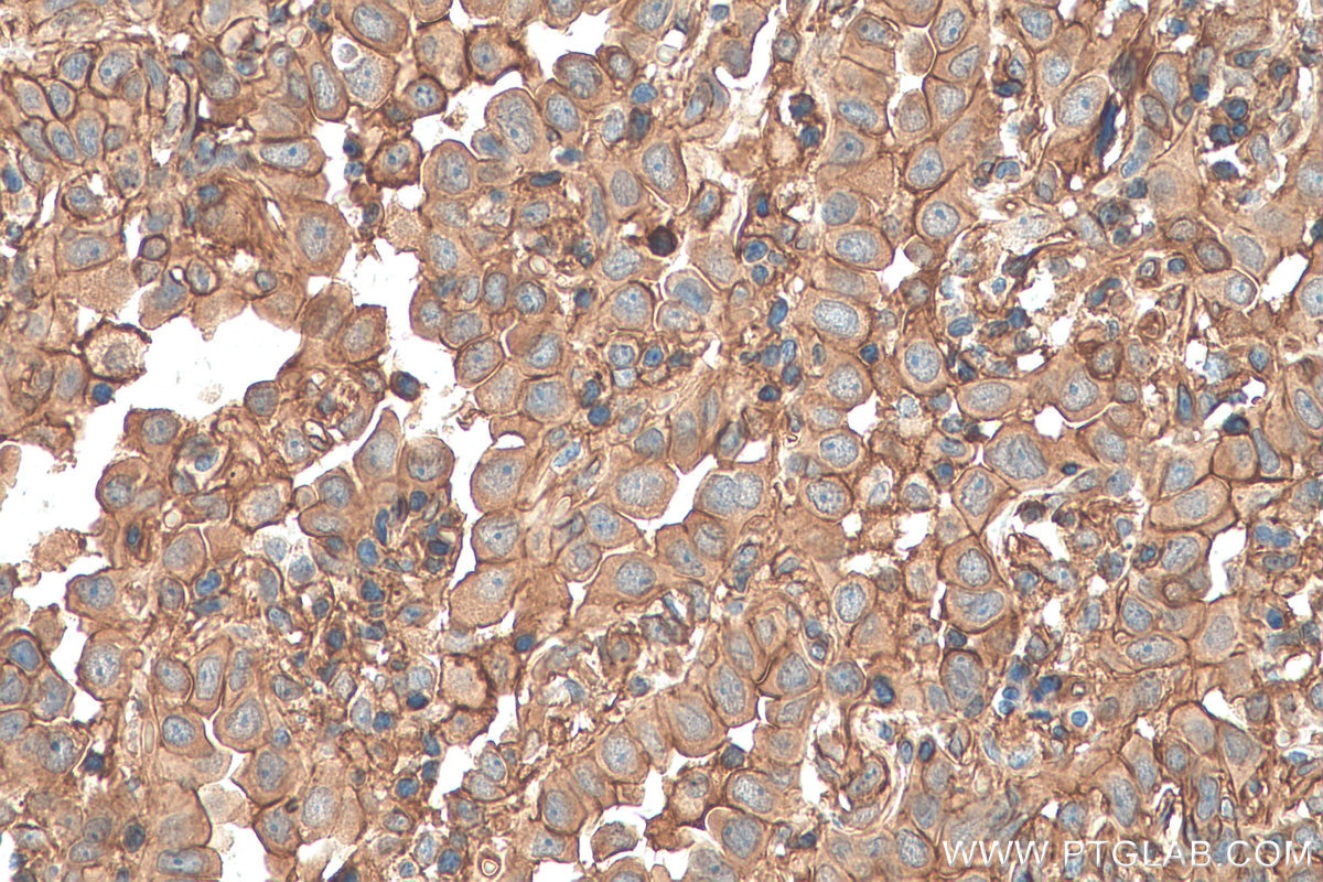 IHC staining of human lung cancer using 11256-1-AP