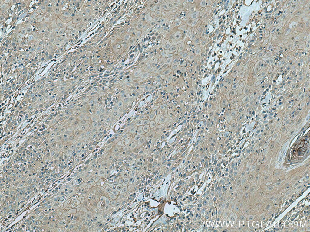 Immunohistochemistry (IHC) staining of human skin cancer tissue using Annexin A2 Monoclonal antibody (60051-1-Ig)