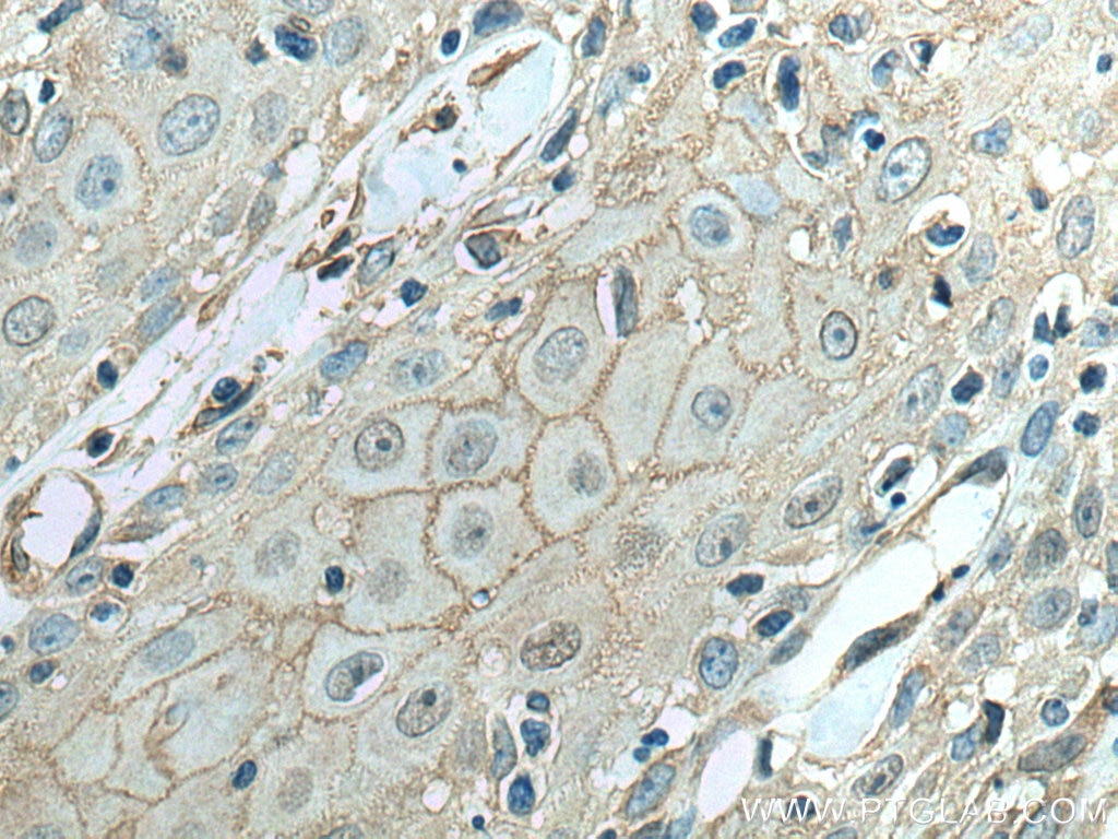 Immunohistochemistry (IHC) staining of human skin cancer tissue using Annexin A2 Monoclonal antibody (60051-1-Ig)