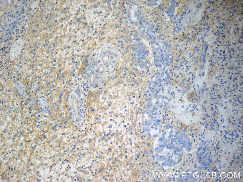 Immunohistochemistry (IHC) staining of human gliomas tissue using Annexin A2 Monoclonal antibody (60051-1-Ig)