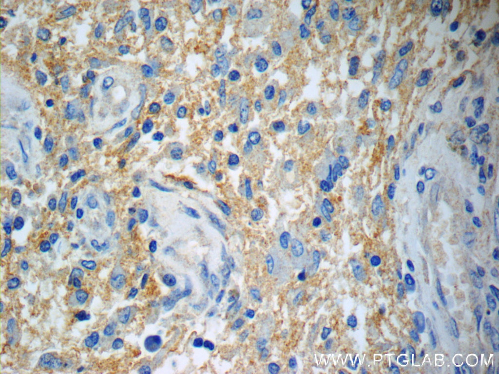 Immunohistochemistry (IHC) staining of human gliomas tissue using Annexin A2 Monoclonal antibody (60051-1-Ig)