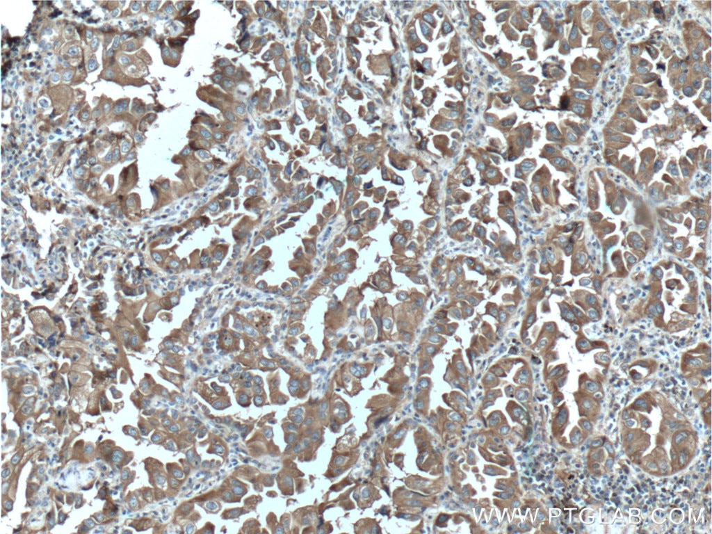 Immunohistochemistry (IHC) staining of human lung cancer tissue using Annexin A2 Monoclonal antibody (60051-1-Ig)