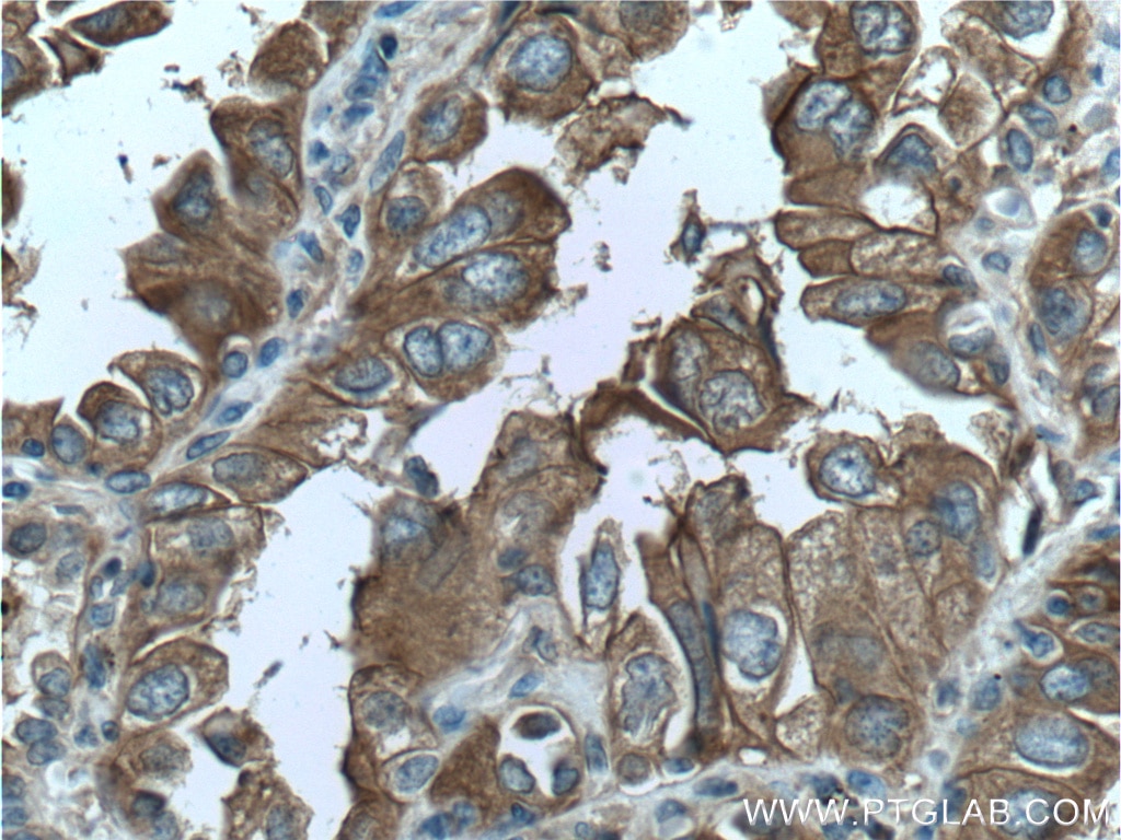 Immunohistochemistry (IHC) staining of human lung cancer tissue using Annexin A2 Monoclonal antibody (60051-1-Ig)