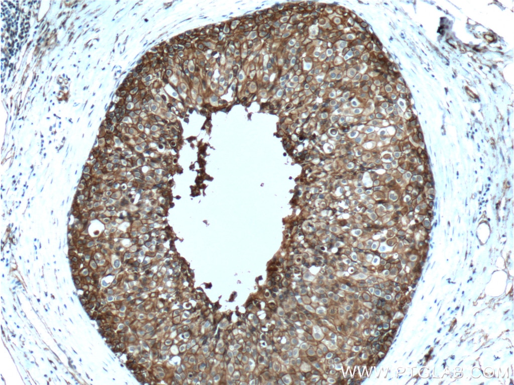 Immunohistochemistry (IHC) staining of human breast cancer tissue using Annexin A2 Monoclonal antibody (60051-1-Ig)