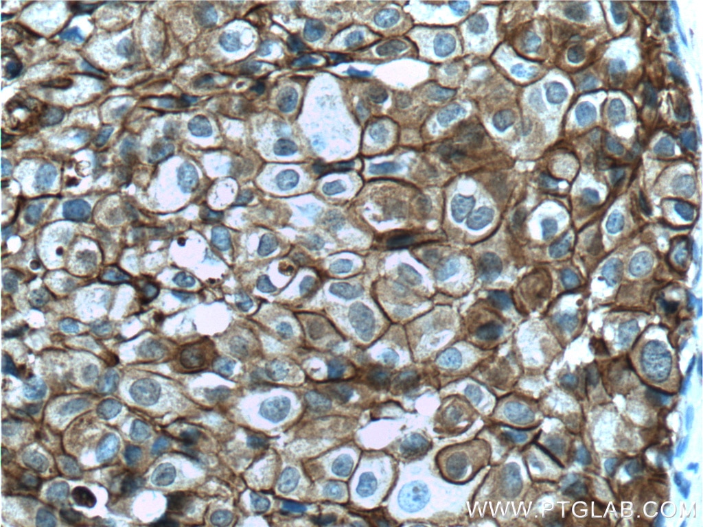 Immunohistochemistry (IHC) staining of human breast cancer tissue using Annexin A2 Monoclonal antibody (60051-1-Ig)