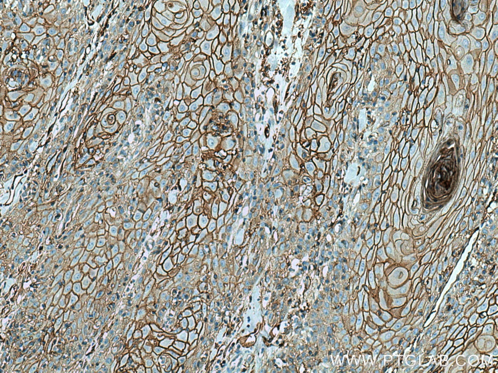 Immunohistochemistry (IHC) staining of human skin cancer tissue using Annexin A2 Monoclonal antibody (66035-1-Ig)