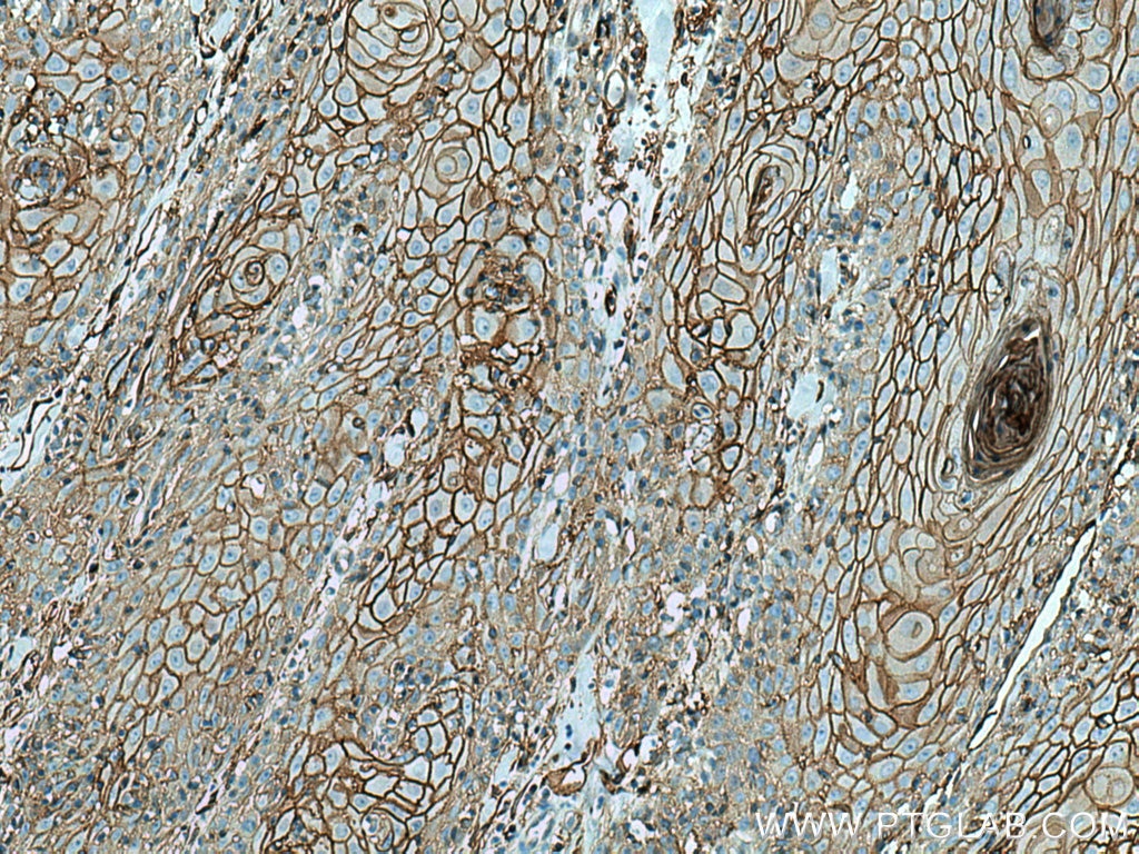 IHC staining of human skin cancer using 66035-1-Ig