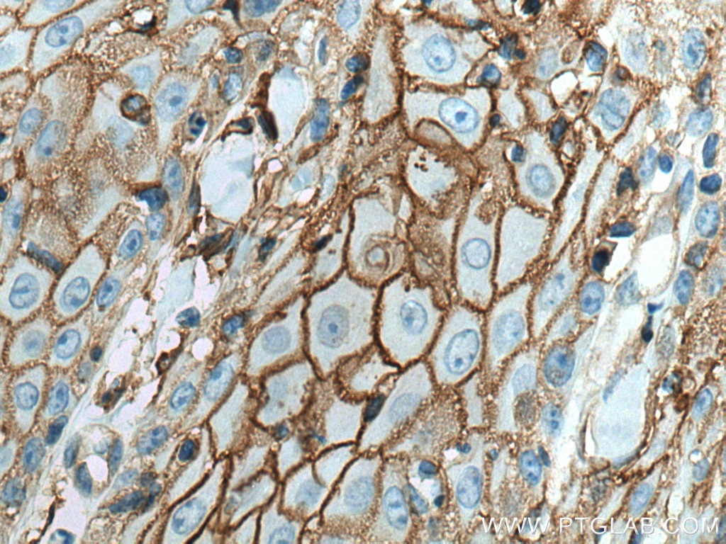 IHC staining of human skin cancer using 66035-1-Ig