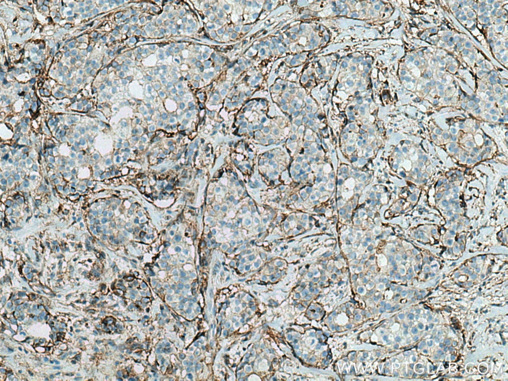 Immunohistochemistry (IHC) staining of human breast cancer tissue using Annexin A2 Monoclonal antibody (66035-1-Ig)
