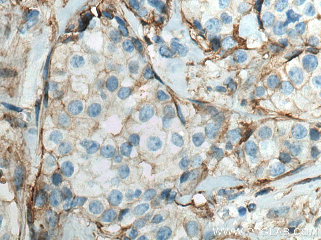 Immunohistochemistry (IHC) staining of human breast cancer tissue using Annexin A2 Monoclonal antibody (66035-1-Ig)