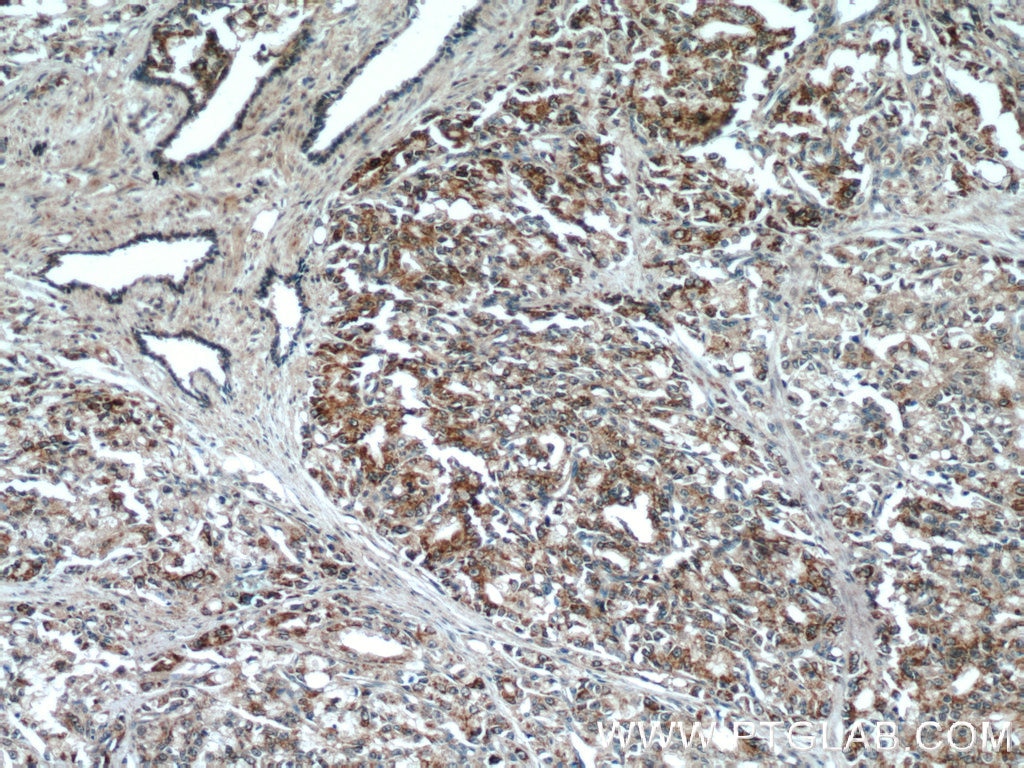 Immunohistochemistry (IHC) staining of human prostate cancer tissue using ANXA2R Polyclonal antibody (23838-1-AP)
