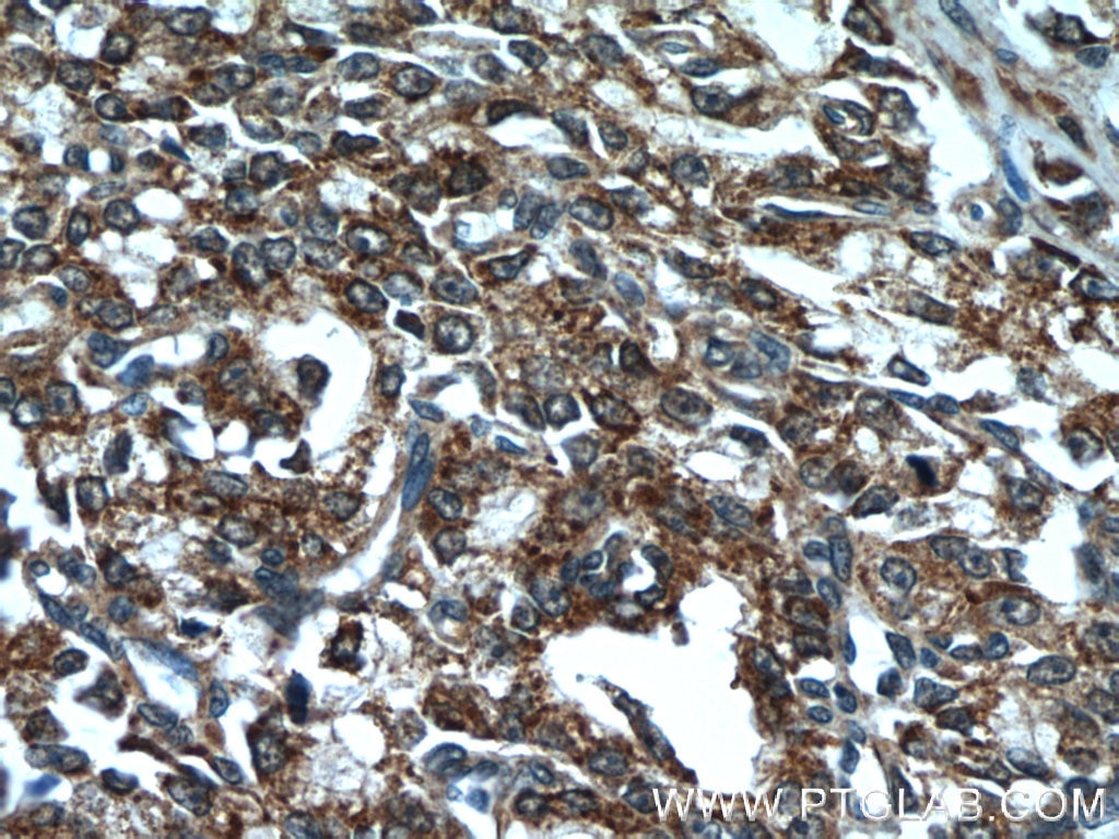 IHC staining of human prostate cancer using 23838-1-AP