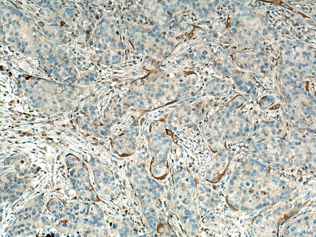 Immunohistochemistry (IHC) staining of human breast cancer tissue using Annexin A3 Polyclonal antibody (11804-1-AP)