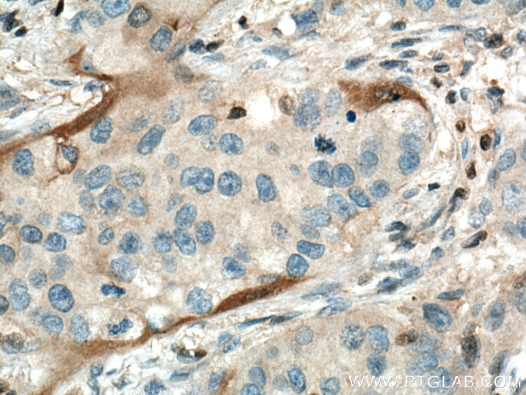 Immunohistochemistry (IHC) staining of human breast cancer tissue using Annexin A3 Polyclonal antibody (11804-1-AP)