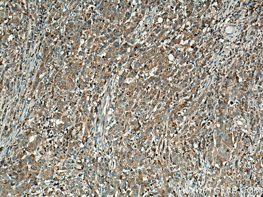 Immunohistochemistry (IHC) staining of human stomach cancer tissue using Annexin A3 Polyclonal antibody (11804-1-AP)