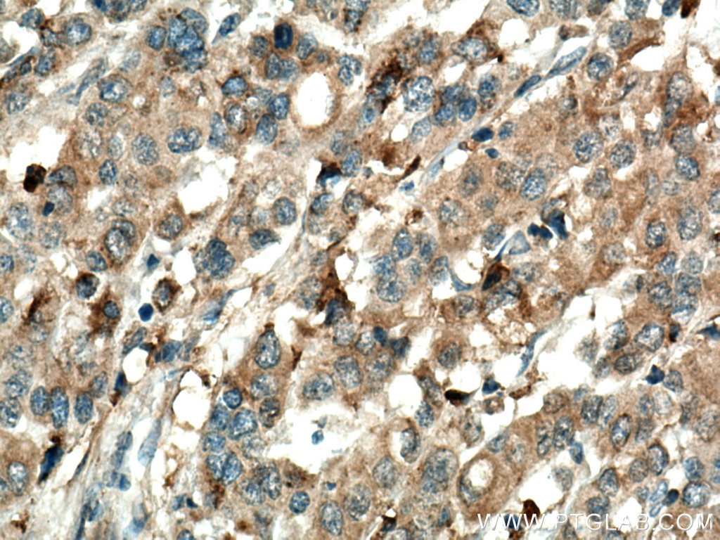 Immunohistochemistry (IHC) staining of human stomach cancer tissue using Annexin A3 Polyclonal antibody (11804-1-AP)
