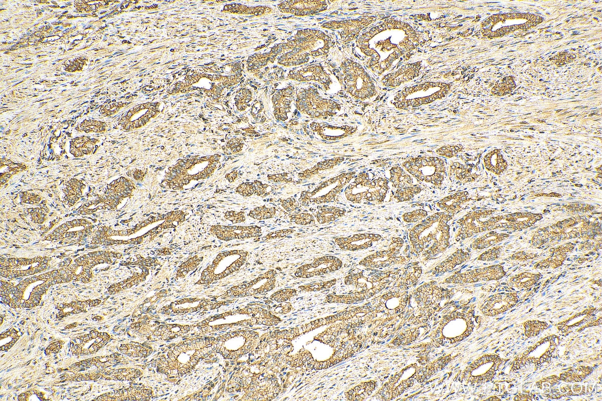 Immunohistochemistry (IHC) staining of human prostate cancer tissue using Annexin A7  Polyclonal antibody (10154-2-AP)