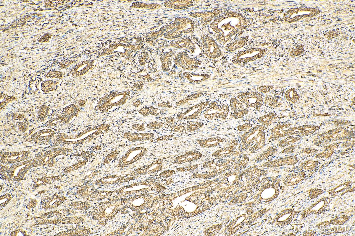 IHC staining of human prostate cancer using 10154-2-AP