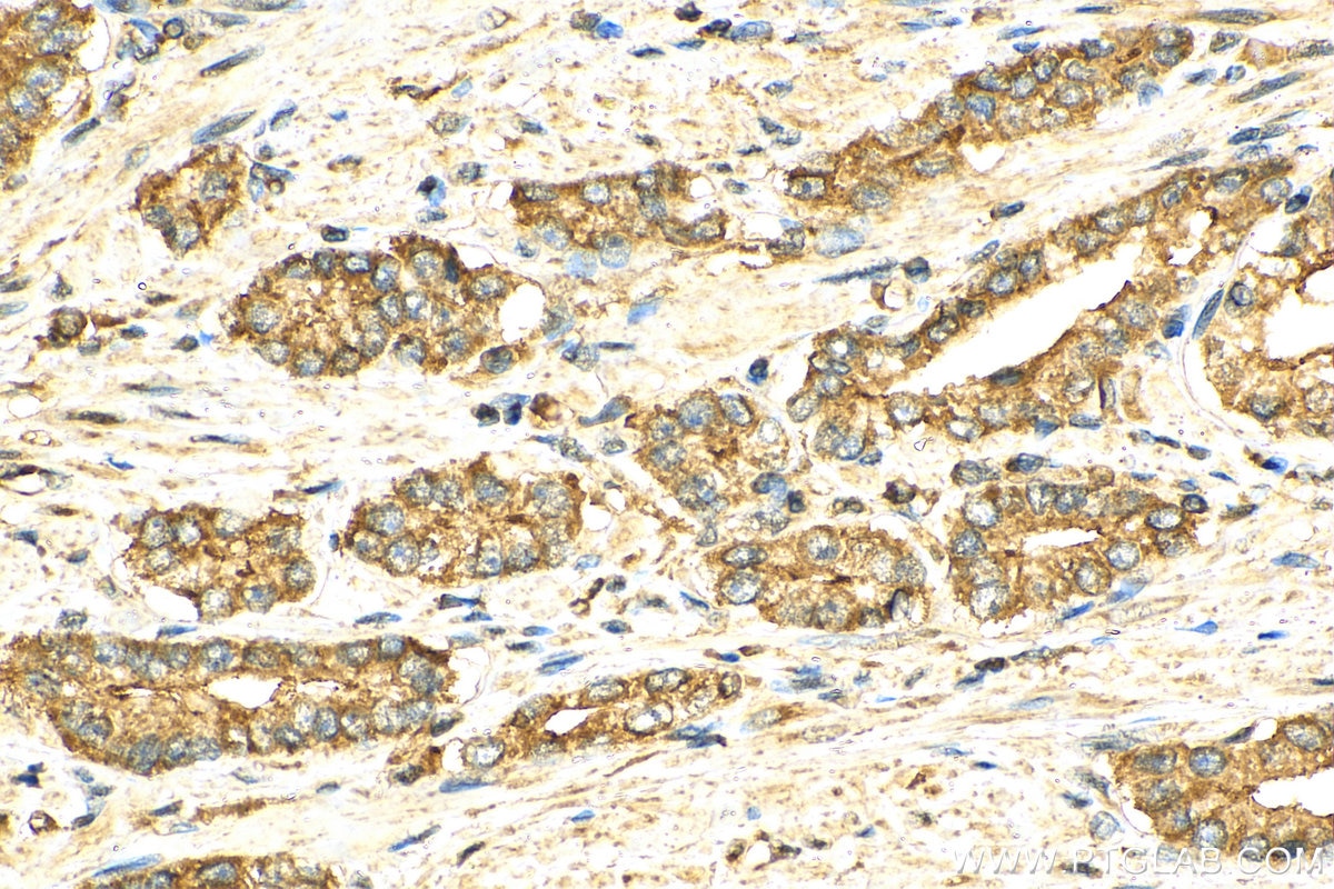 Immunohistochemistry (IHC) staining of human prostate cancer tissue using Annexin A7  Polyclonal antibody (10154-2-AP)