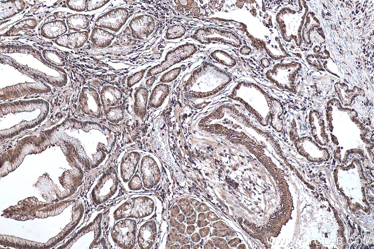 IHC staining of human stomach cancer using 10154-2-AP