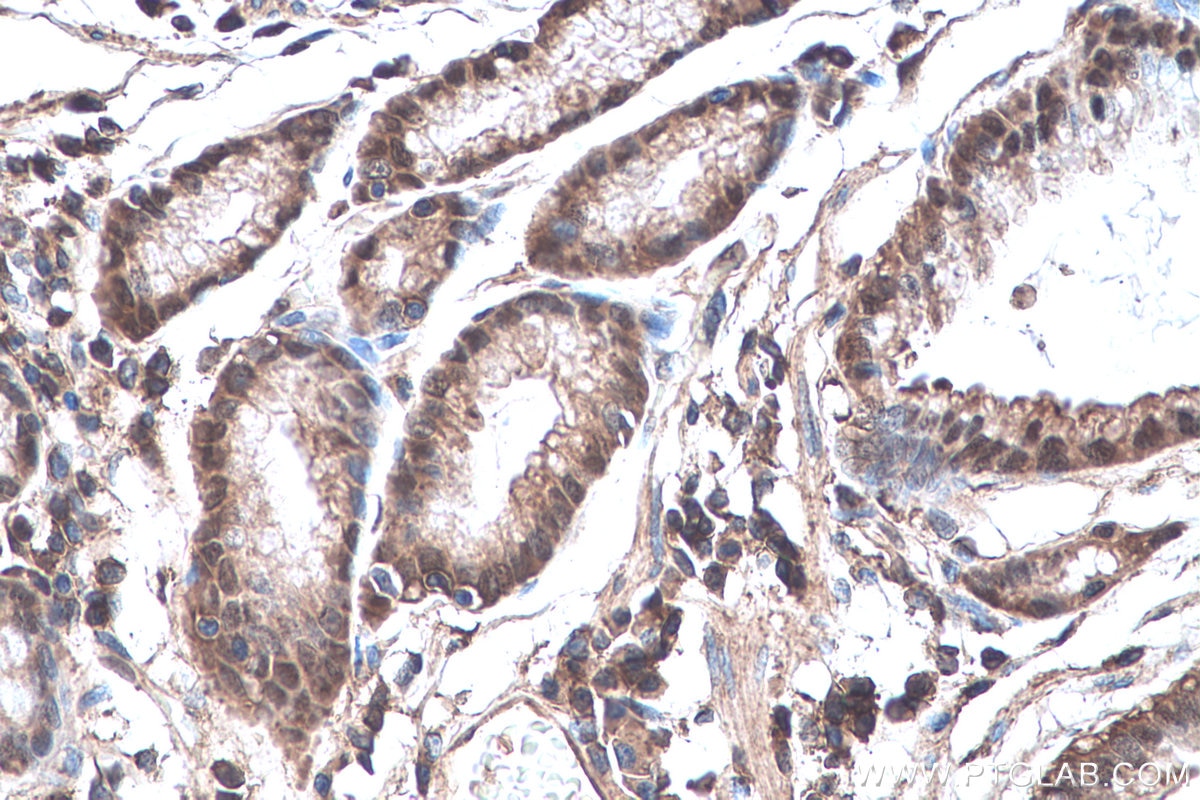 Immunohistochemistry (IHC) staining of human stomach cancer tissue using Annexin A7  Polyclonal antibody (10154-2-AP)