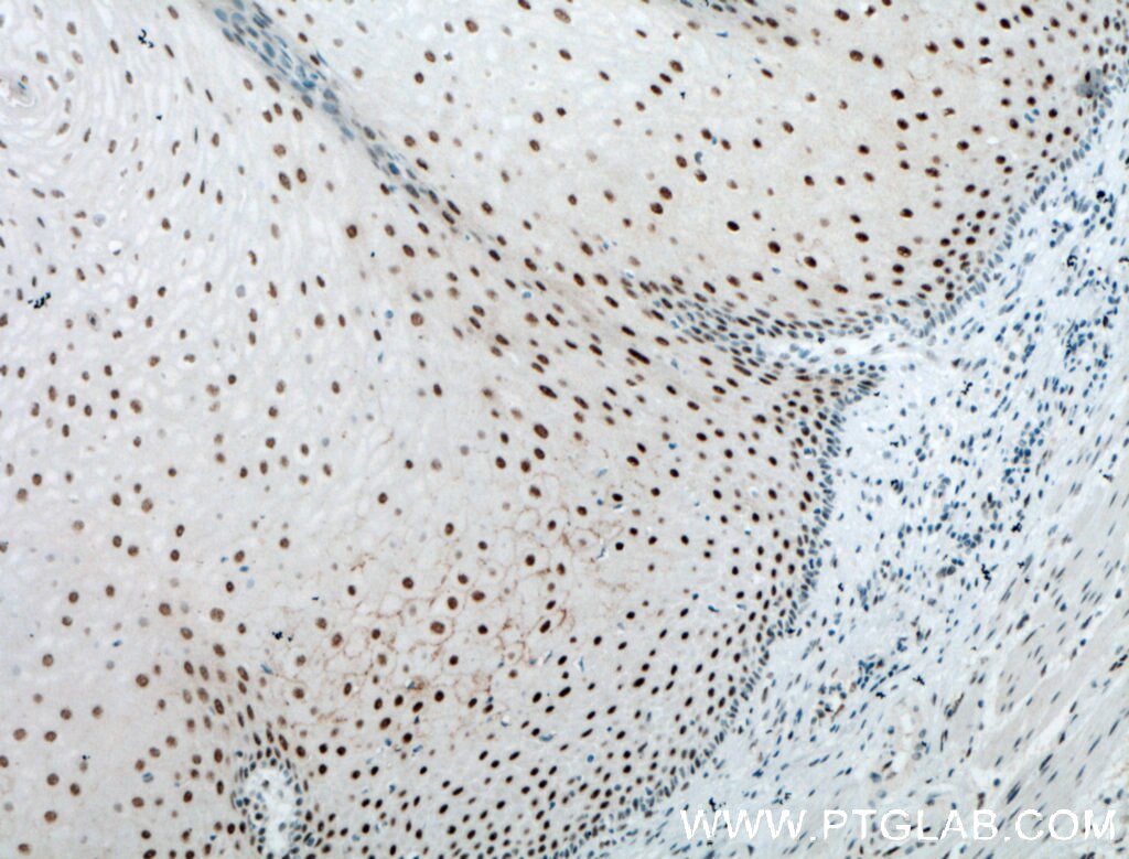 Immunohistochemistry (IHC) staining of human oesophagus cancer tissue using Annexin VIII Polyclonal antibody (10462-1-AP)
