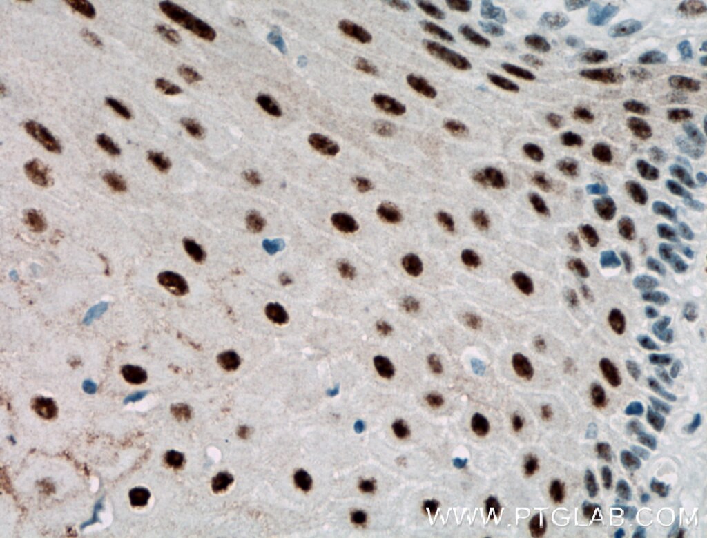 IHC staining of human oesophagus cancer using 10462-1-AP