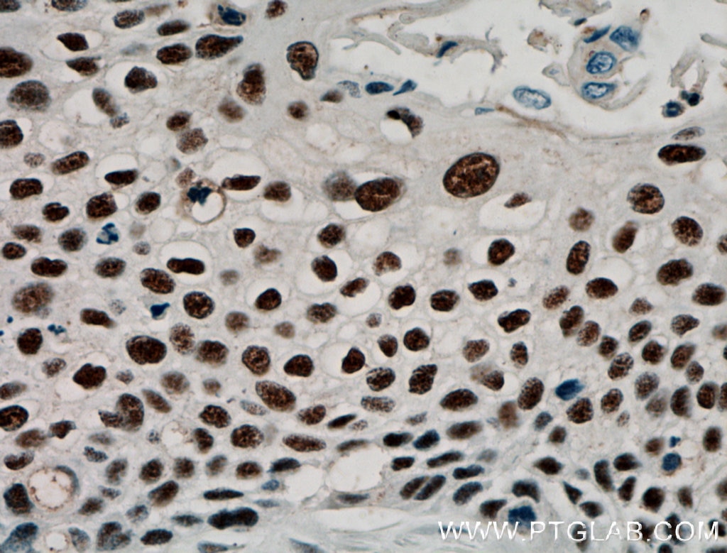 Immunohistochemistry (IHC) staining of human oesophagus cancer tissue using Annexin VIII Polyclonal antibody (10462-1-AP)