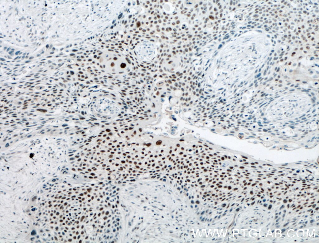 Immunohistochemistry (IHC) staining of human oesophagus cancer tissue using Annexin VIII Polyclonal antibody (10462-1-AP)