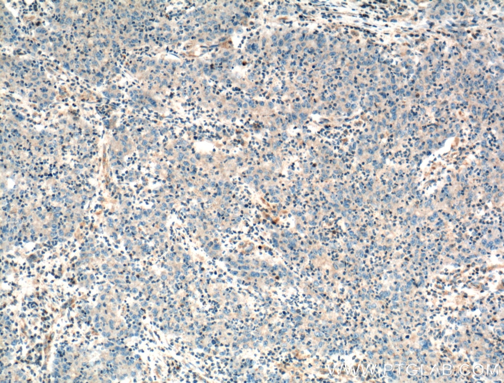 Immunohistochemistry (IHC) staining of human colon cancer tissue using ANXA9 Polyclonal antibody (15416-1-AP)