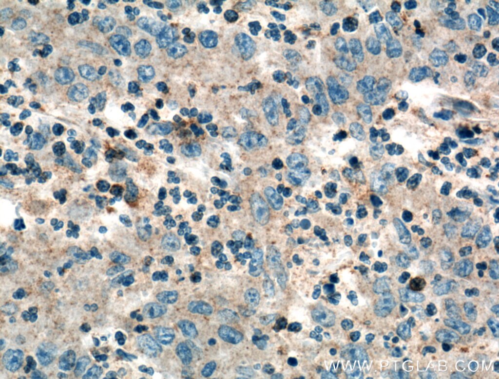 IHC staining of human colon cancer using 15416-1-AP