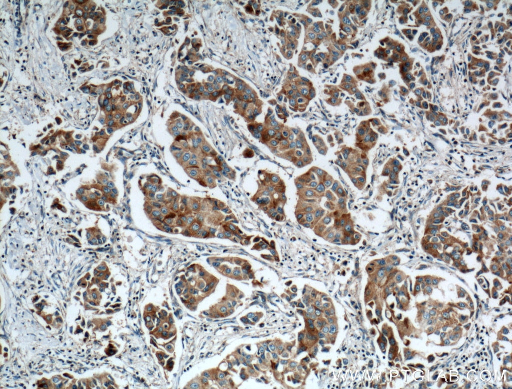 IHC staining of human breast cancer using 15416-1-AP