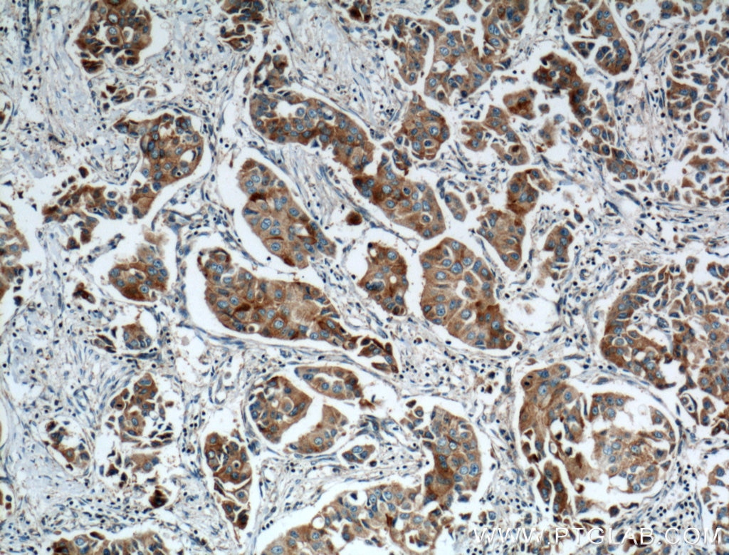 Immunohistochemistry (IHC) staining of human breast cancer tissue using ANXA9 Polyclonal antibody (15416-1-AP)