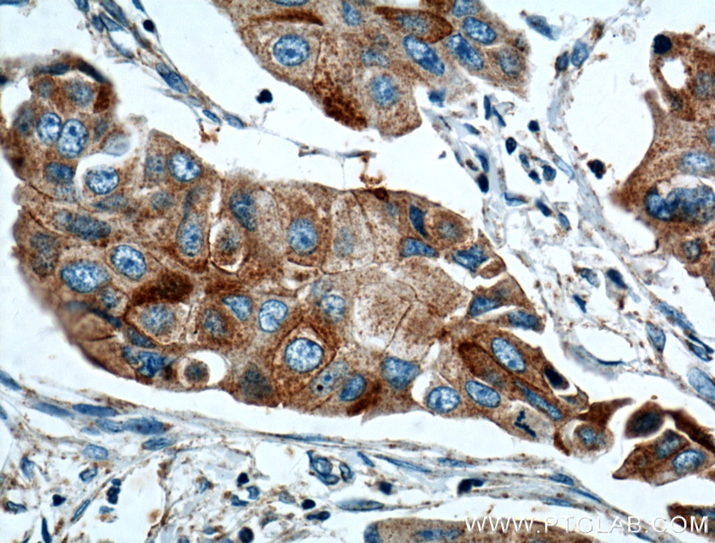 Immunohistochemistry (IHC) staining of human breast cancer tissue using ANXA9 Polyclonal antibody (15416-1-AP)