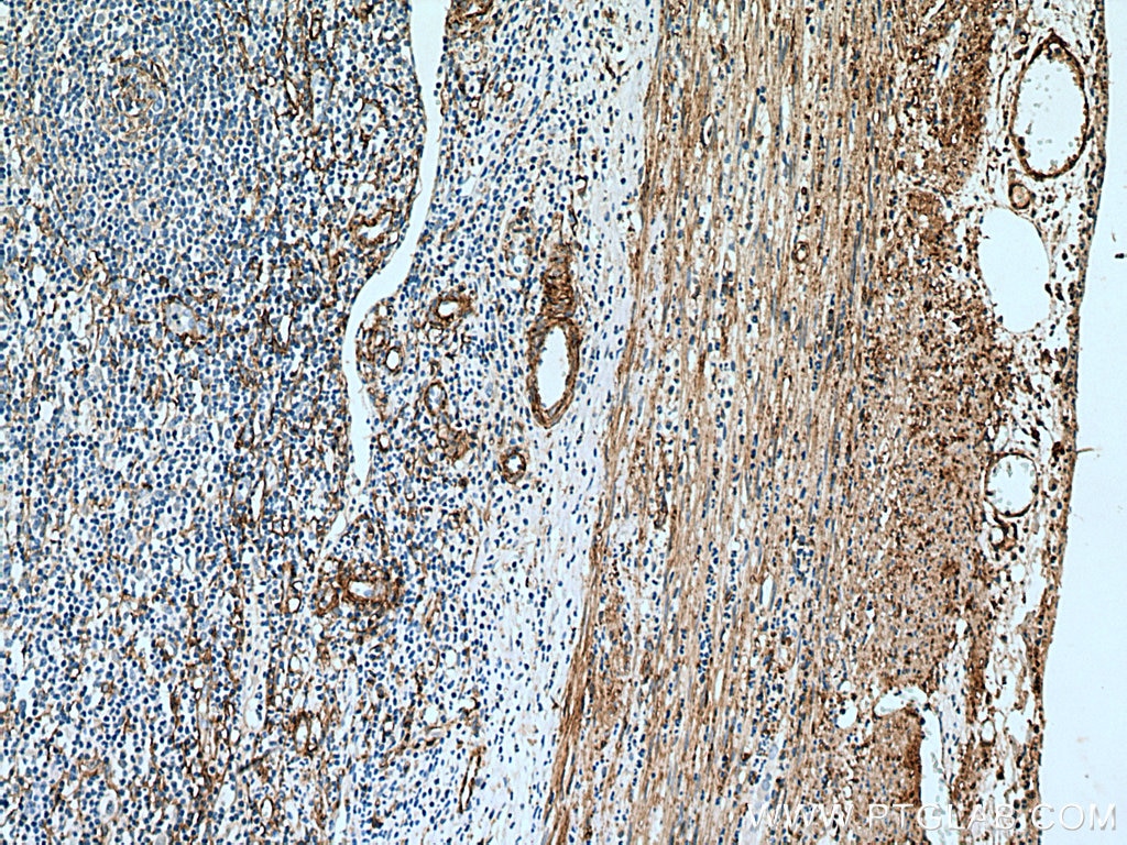 IHC staining of human appendicitis using 14365-1-AP