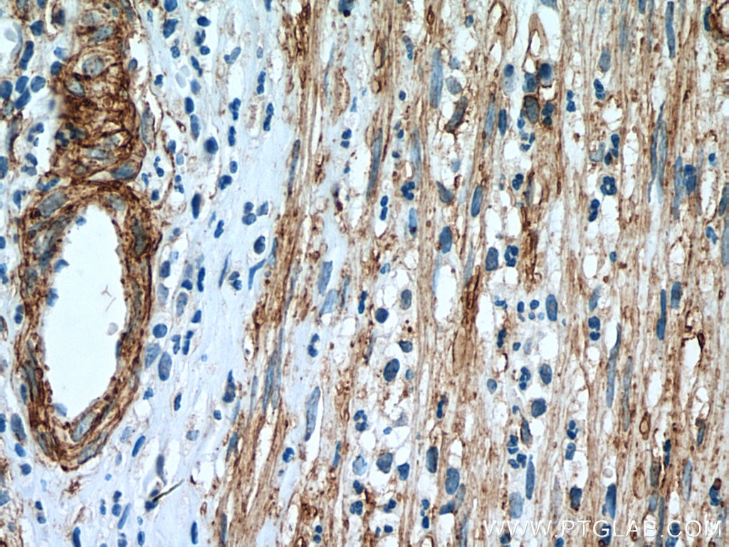 Immunohistochemistry (IHC) staining of human appendicitis tissue using VAP1 Polyclonal antibody (14365-1-AP)