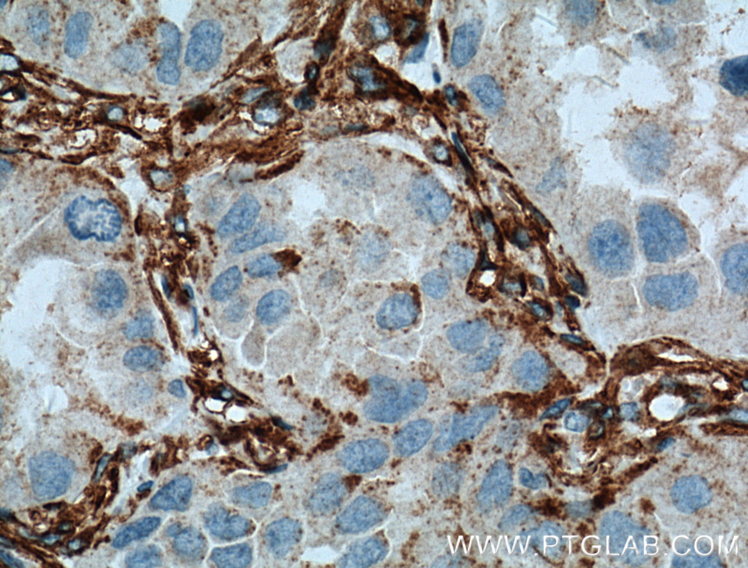 Immunohistochemistry (IHC) staining of human lung cancer tissue using VAP1 Polyclonal antibody (14365-1-AP)