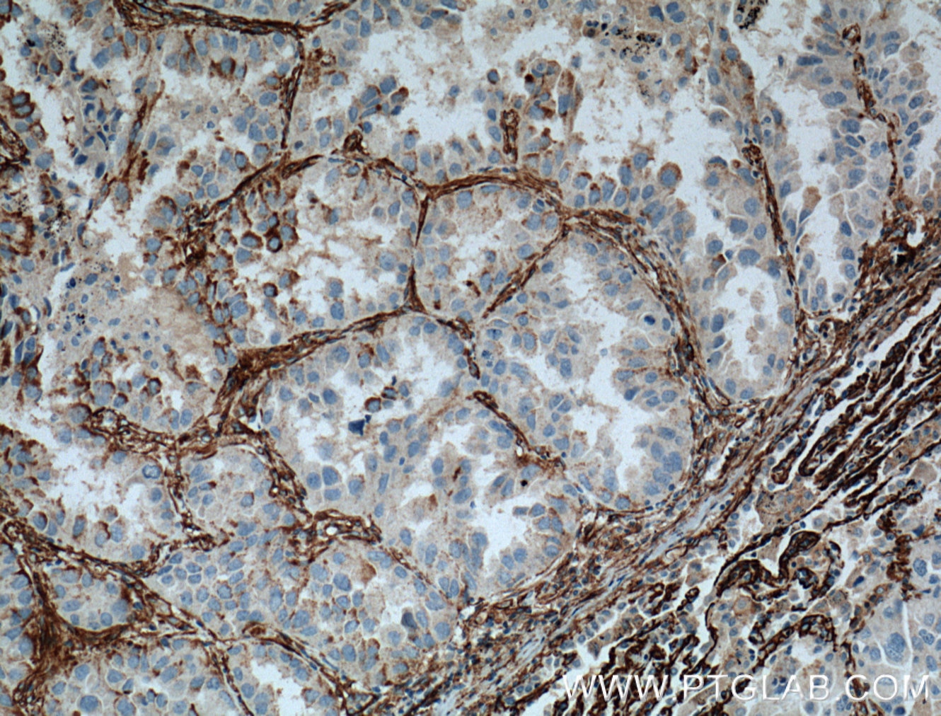 Immunohistochemistry (IHC) staining of human lung cancer tissue using VAP1 Polyclonal antibody (14365-1-AP)