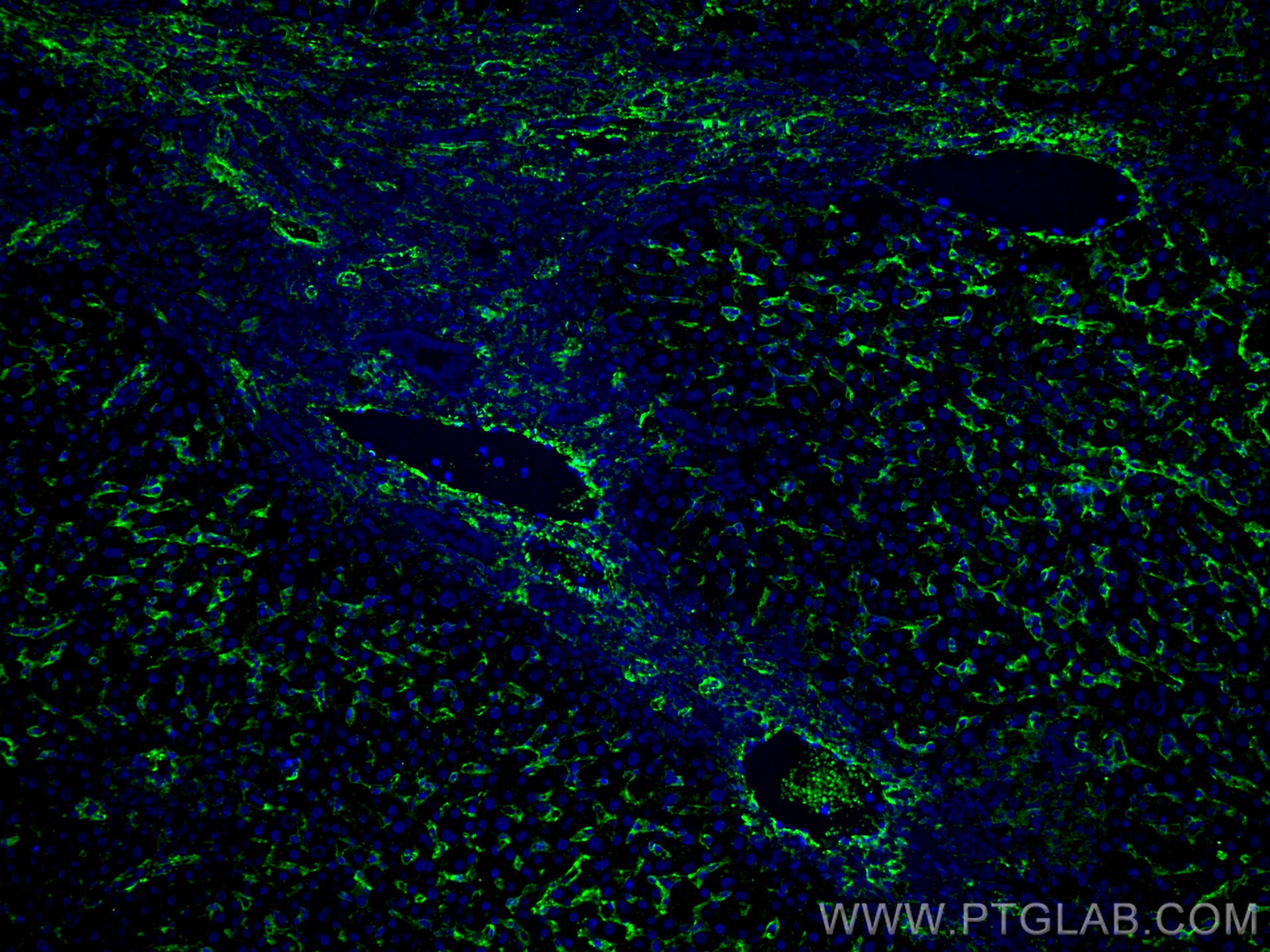 Immunofluorescence (IF) / fluorescent staining of human liver cancer tissue using AOC3 Monoclonal antibody (66834-1-Ig)