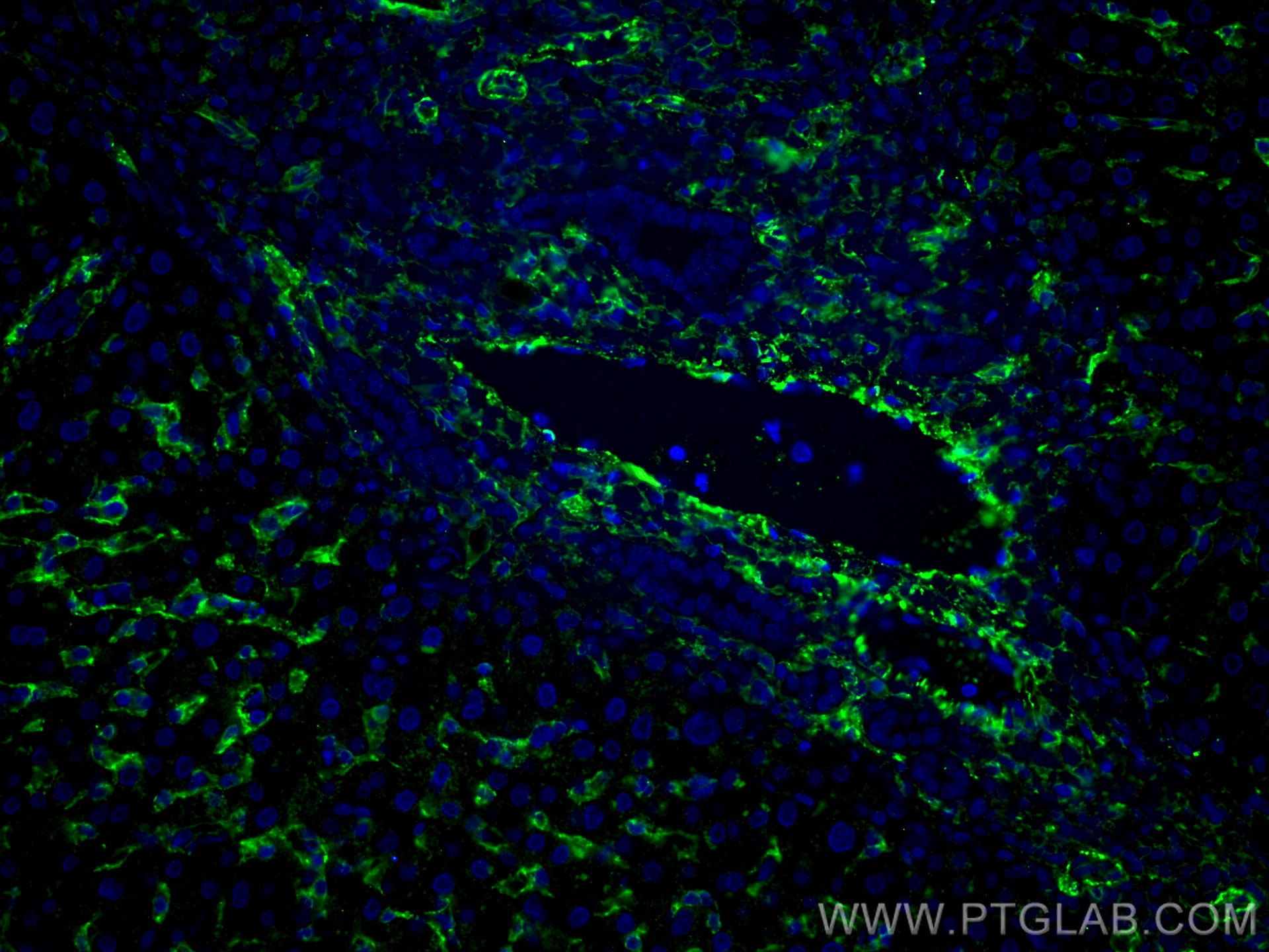 Immunofluorescence (IF) / fluorescent staining of human liver cancer tissue using AOC3 Monoclonal antibody (66834-1-Ig)