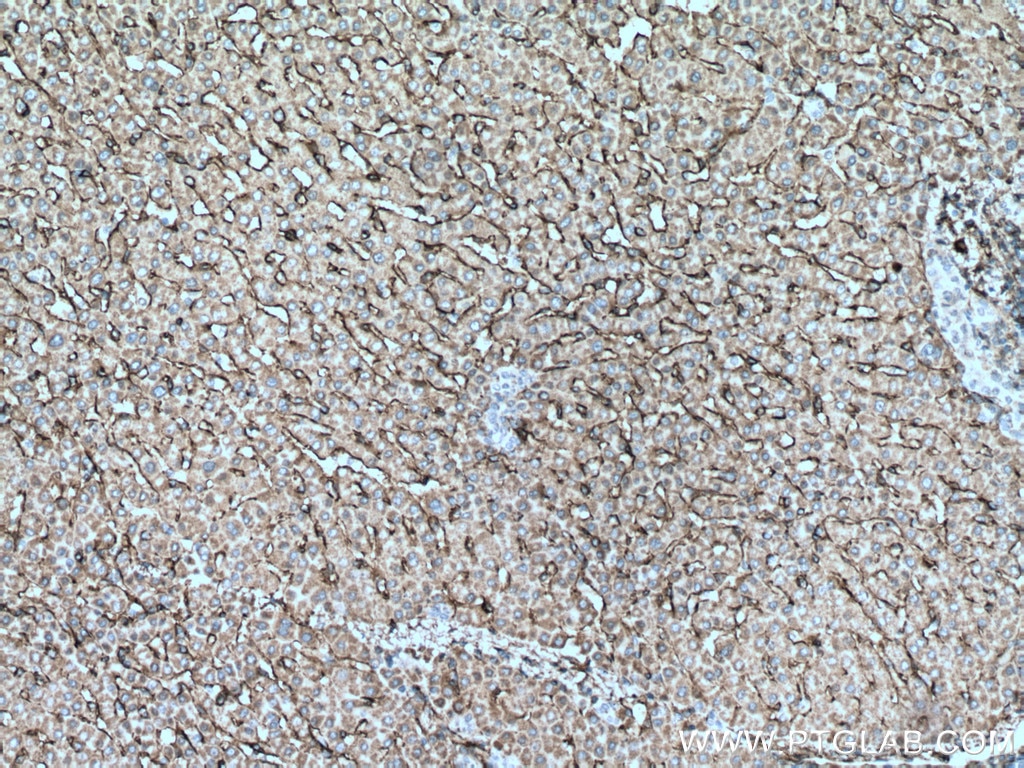 Immunohistochemistry (IHC) staining of human liver cancer tissue using AOC3 Monoclonal antibody (66834-1-Ig)