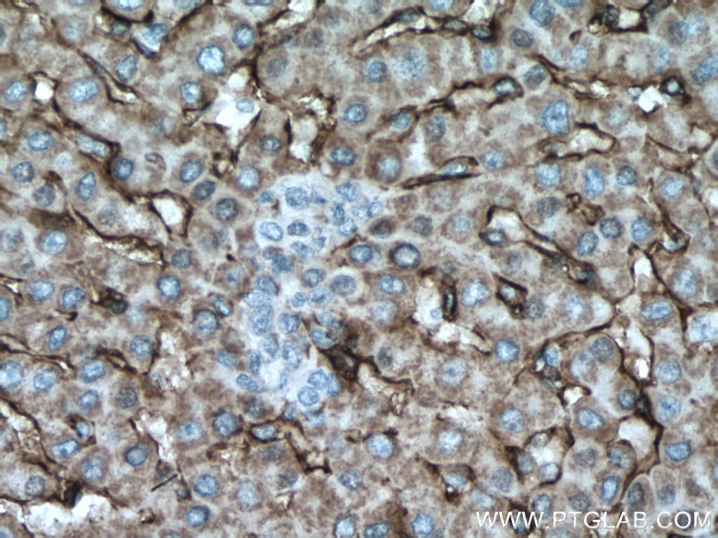 Immunohistochemistry (IHC) staining of human liver cancer tissue using AOC3 Monoclonal antibody (66834-1-Ig)