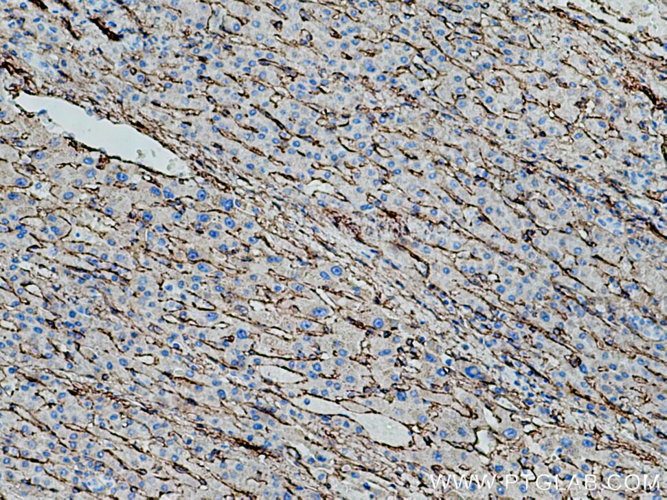 Immunohistochemistry (IHC) staining of human liver cancer tissue using AOC3 Monoclonal antibody (66834-1-Ig)