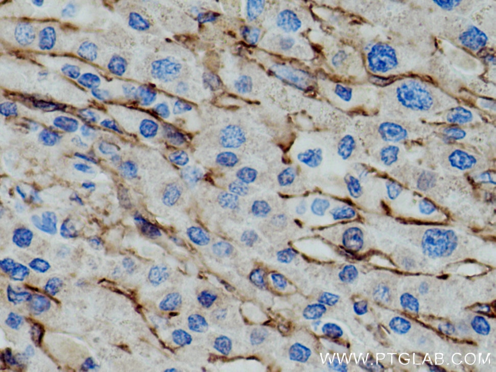 Immunohistochemistry (IHC) staining of human liver cancer tissue using AOC3 Monoclonal antibody (66834-1-Ig)