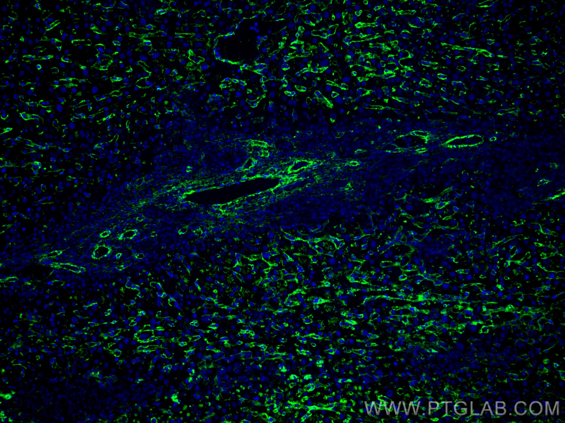 Immunofluorescence (IF) / fluorescent staining of human liver cancer tissue using CoraLite® Plus 488-conjugated AOC3 Monoclonal anti (CL488-66834)